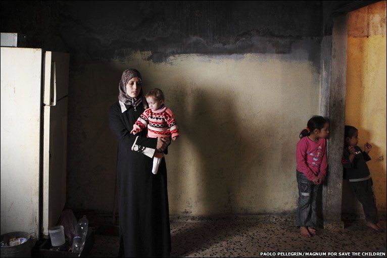 Gizi buruk yang parah dialami oleh anak=anak Palestina