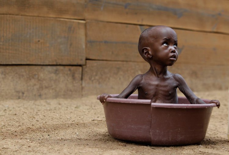 Malnutrition. :(