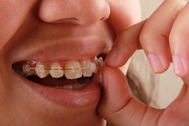 wax orthodonty