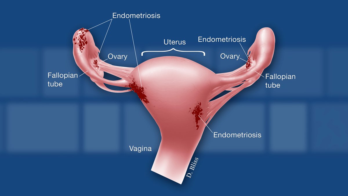 Waspada Endometriosis dan Fibroid Seperti yang Dialami Oleh Zaskia