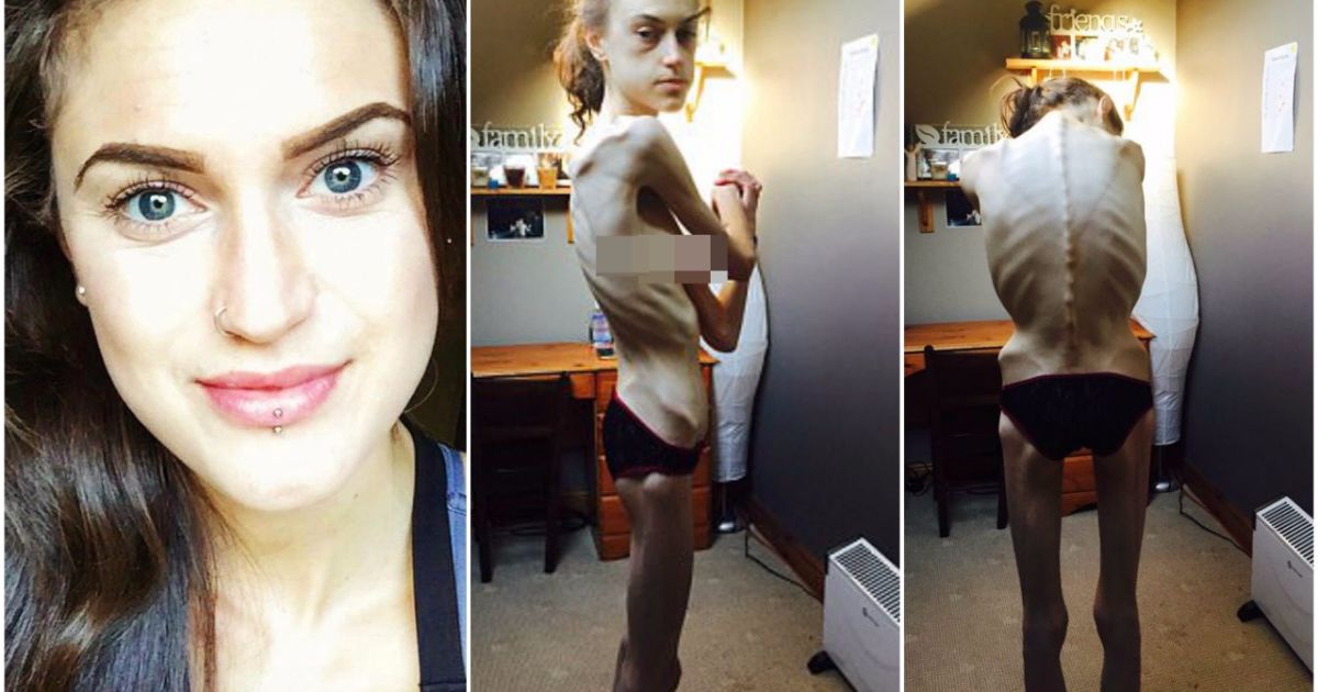 Obsesi Menurunkan Berat Badan Bisa Berujung Maut, Kita