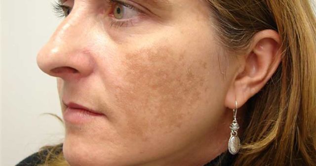 bedanya freckles dan flek hitam