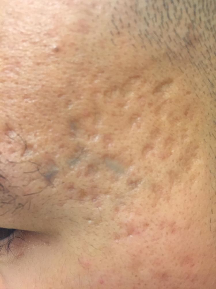 Bukan Cuma Bopeng, 7 Tipe Bekas Jerawat Plus Cara Mengatasinya Ini