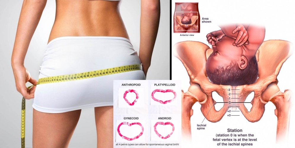4 Bentuk Panggul Wanita Yang Memengaruhi Proses Persalinan Bukan Penentu Tapi Kamu Layak Tahu