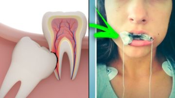 Tanpa Operasi, Ini 7 Cara Agar Gigi Geraham Bungsu yang Salah Tumbuh