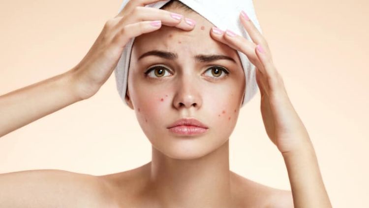 Cara Menggunakan Minyak But But Untuk Jerawat