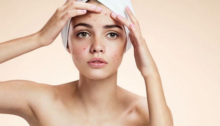 5 Kebiasaan Sepele Yang Bikin Jerawat Muncul Lagi Dan Lagi Muka Jadi Nggak Mulus Begini 5 Kebiasaan Sepele Yang Bikin Jerawat Muncul Lagi Dan Lagi Muka Jadi Nggak Mulus Begini