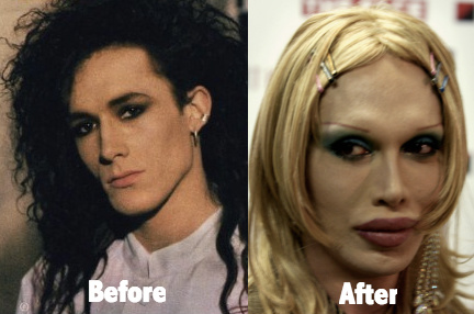Pete Burns Sebelum dan Sesudah Operasi